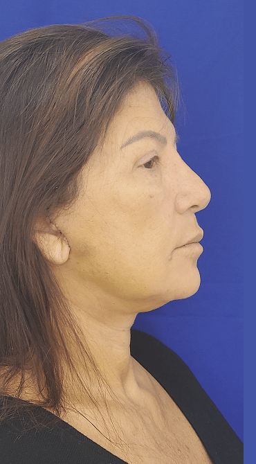 Lifting Facial - Después