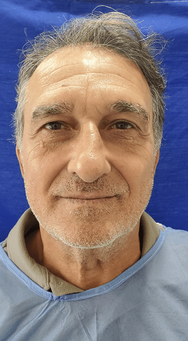 Lifting Facial - Antes