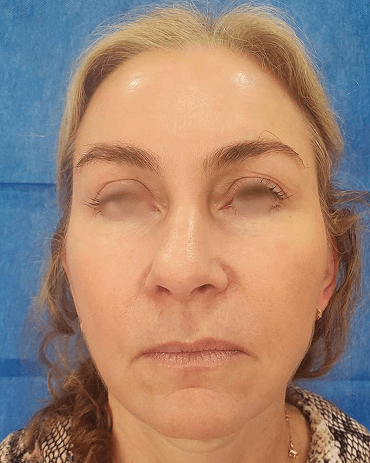 Lifting Facial - Después
